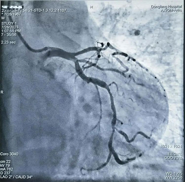 437ccm必赢国际心血管内科医疗中心完成首例OCT指导下冠脉支架植入术